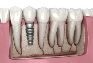 Learn the Basics of the Dental Implants Procedure